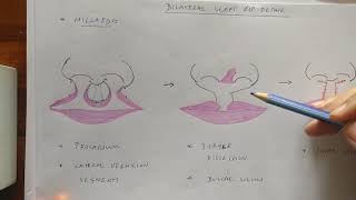 Cleft Lip and Palate  Pathophysiology Causes amp Management [upl. by Anitsud590]