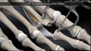 Plantar Plate Repair [upl. by Mattias539]