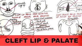 Speech Therapy for Cleft Related Speech Disorders [upl. by Atekal]