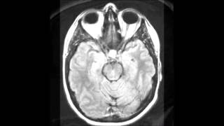 Rathke’s Cleft Cyst [upl. by Nosnorb620]