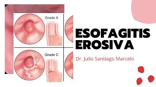 Esofagitis Erosiva [upl. by Cirilo]